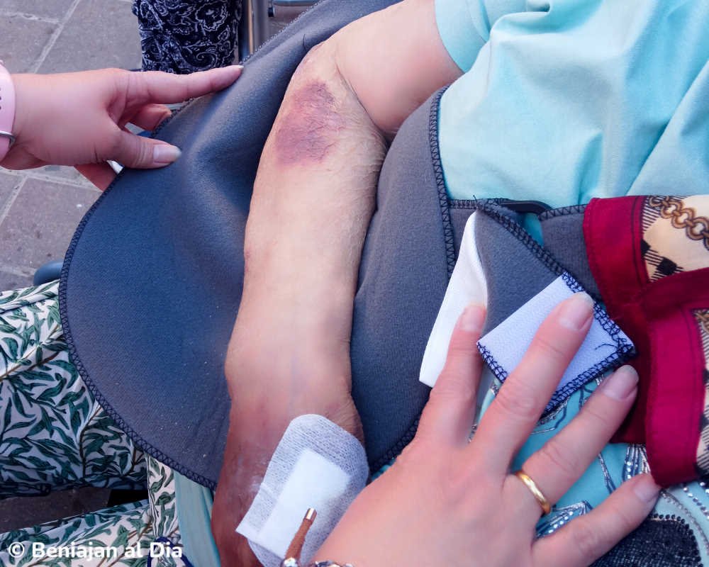 Herida en el brazo de Manoli tras la caída en Beniaján